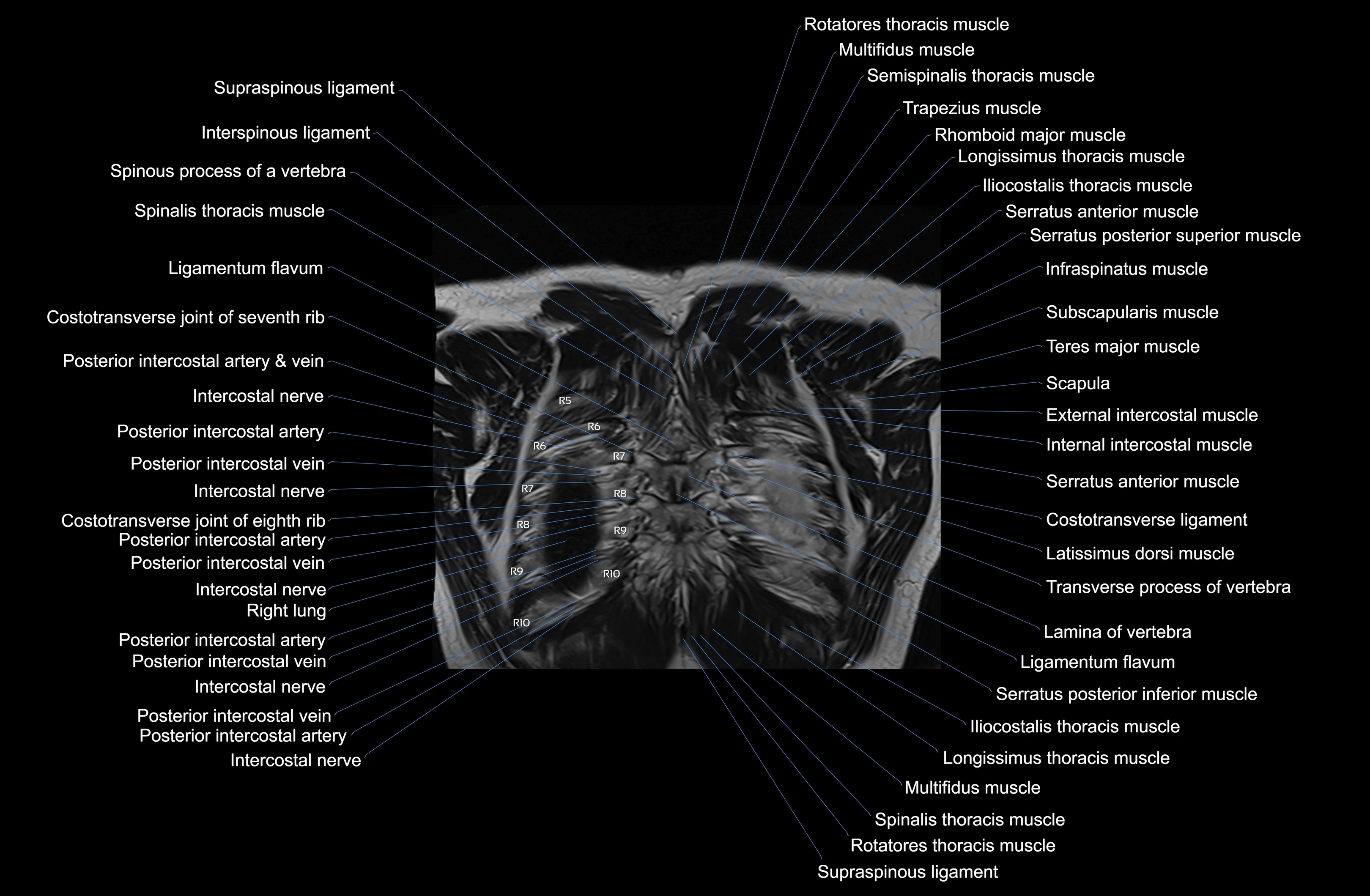 MRI chest (thorax) coronal  cross sectional anatomy 3T radiology  image-img-00001-00039.webp